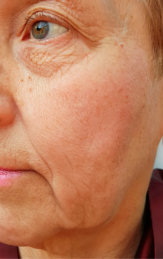 Paciente antes del tratamiento de firmeza facial